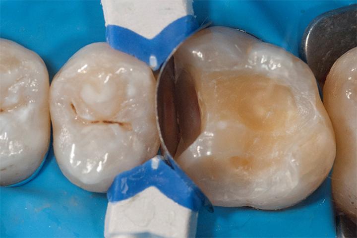 Skuteczne Metody Wypełniania Ubytków w Elewacji – Przewodnik Po Najlepszych Rozwiązaniach