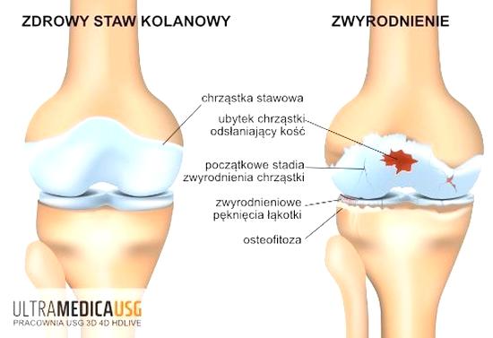 Sklerotyzacja stropu panewki